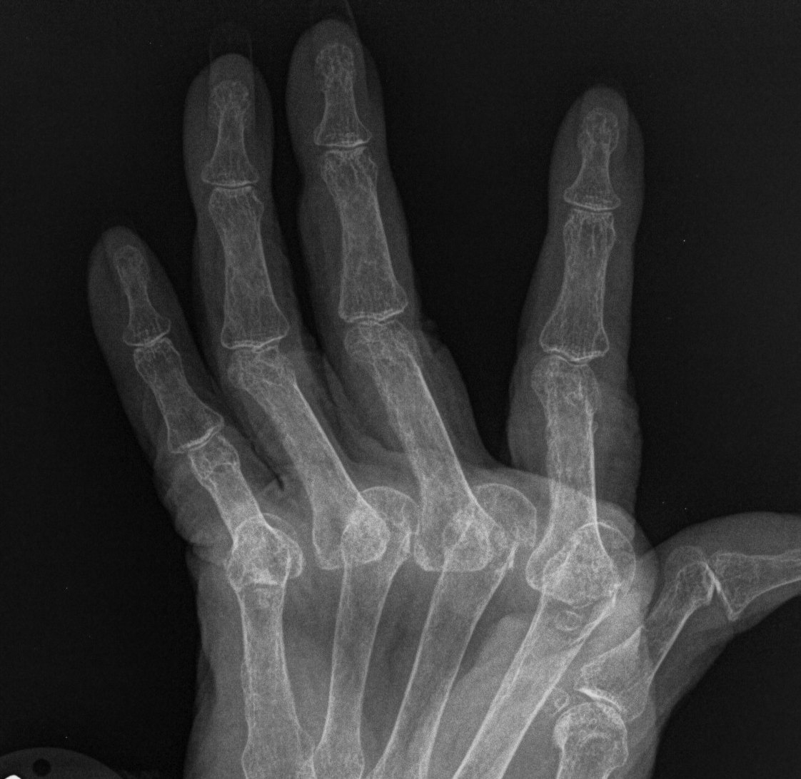 Rheumatoid MCPJ